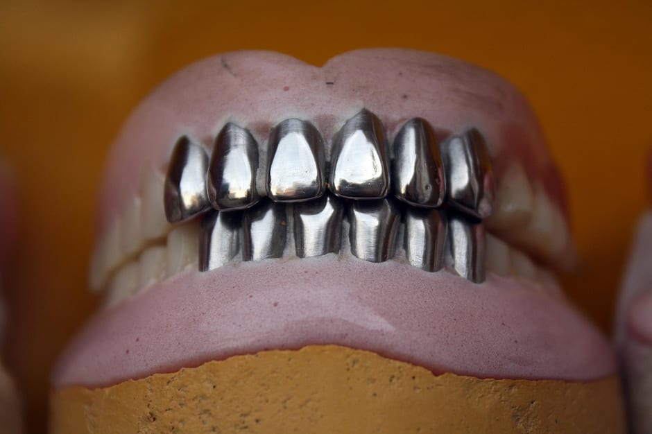 신경치료 후 통증, 정상 범위와 재진료 신호 구분법 관련 임플란트 모형 (참고 이미지)