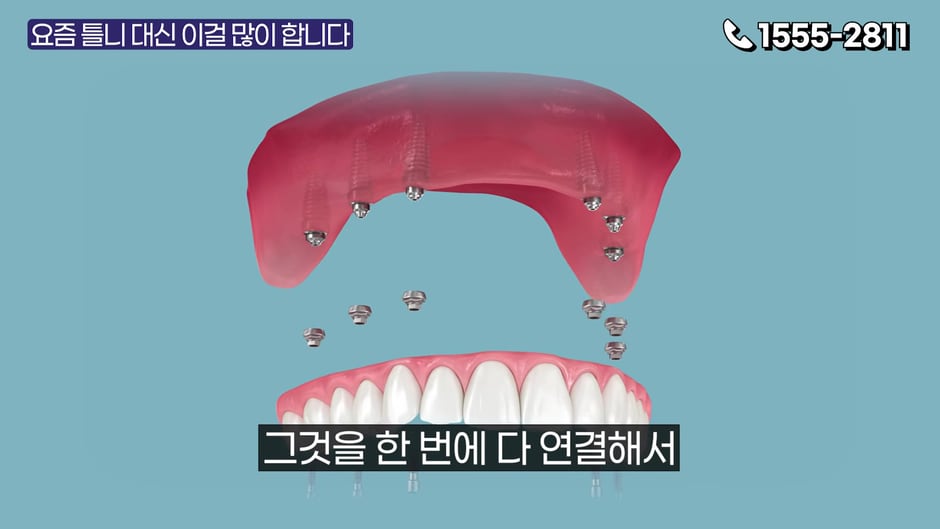 임플란트 틀니(오버덴처) 구조 — 임플란트에 틀니를 연결하는 방식 (영상 캡처)