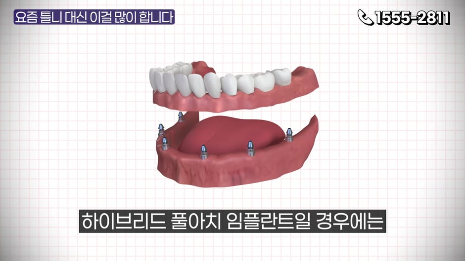 하이브리드 풀아치 임플란트 보철 3D 그래픽 (영상 캡처)