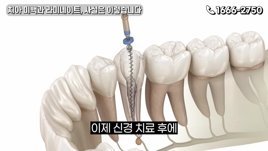신경치료 후 내부 변색이 생기는 치아 구조 그래픽 (영상 캡처)