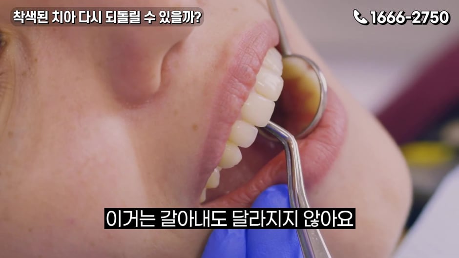치아 착색·변색 상태를 확인하는 진료 장면 (영상 캡처)